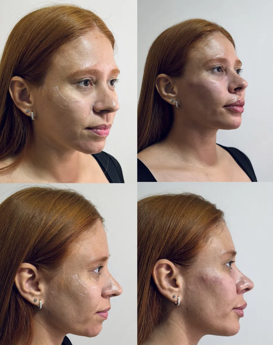 Antes e depois de harmonização facial — vistas de três quartos e perfil