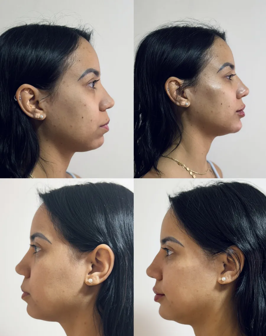 Antes e depois de harmonização facial — vistas de frente e de perfil