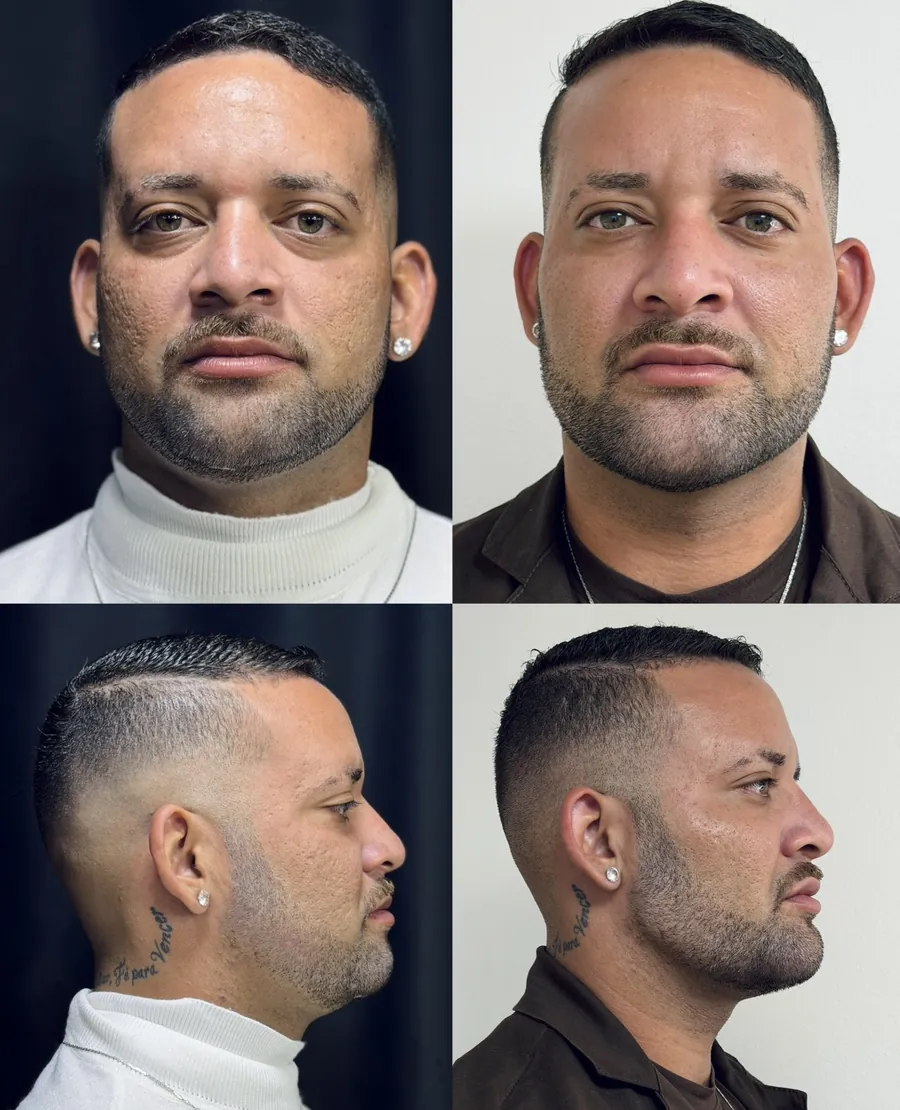 Antes e depois de harmonização facial masculina — vistas de frente e de perfil