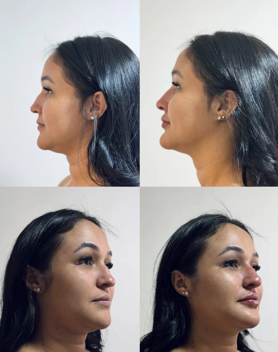 Antes e depois de harmonização facial — perfil e três quartos