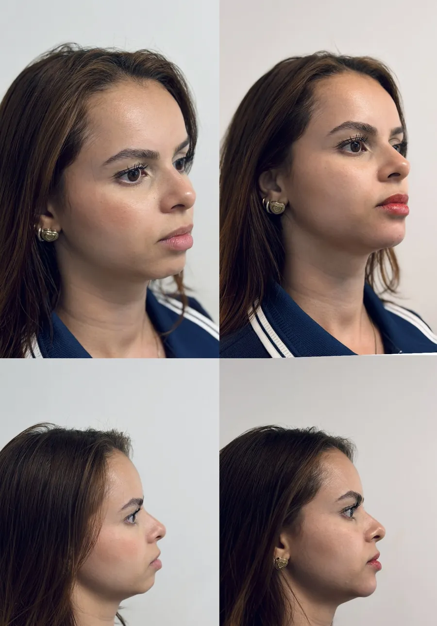 Antes e depois de harmonização facial — três quartos e perfil