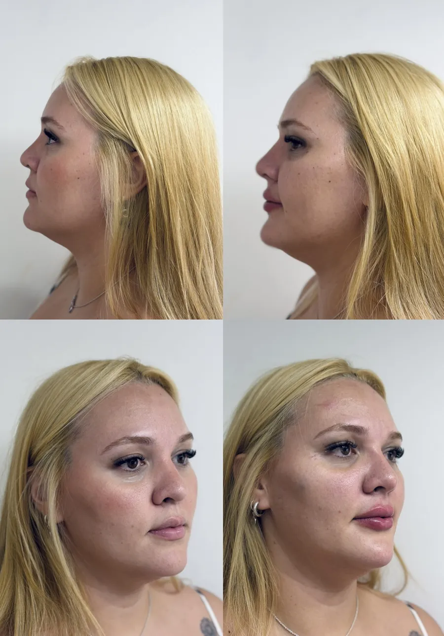 Antes e depois de harmonização facial — perfil e três quartos