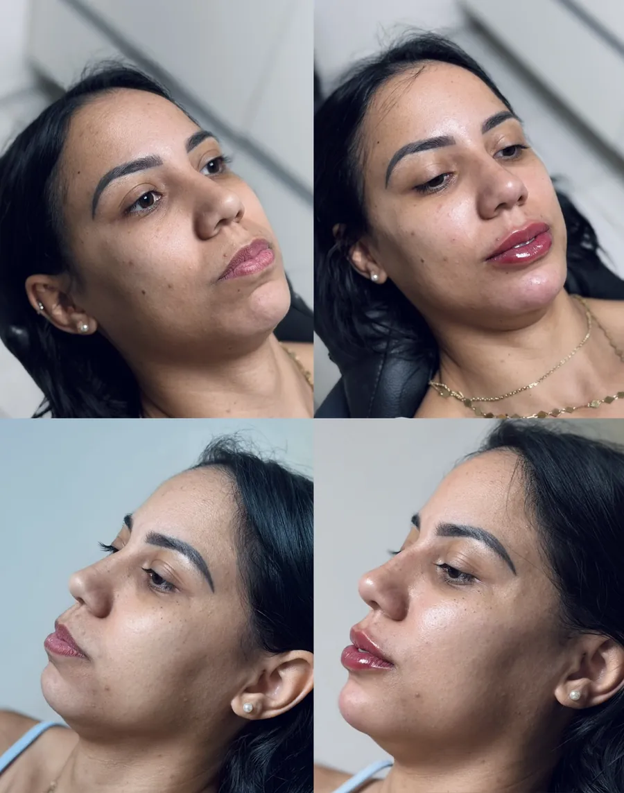 Antes e depois de harmonização facial com foco nos lábios