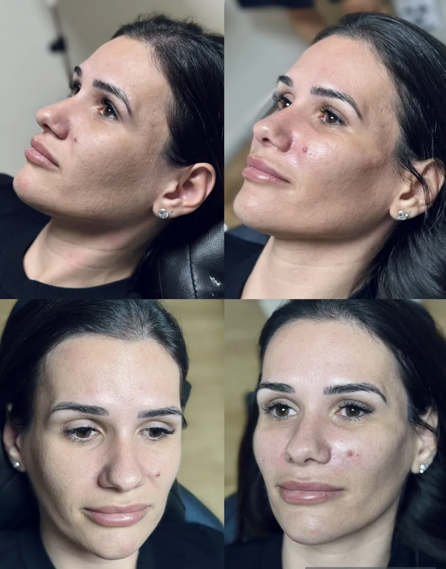 Antes e depois de harmonização facial — três quartos e frente
