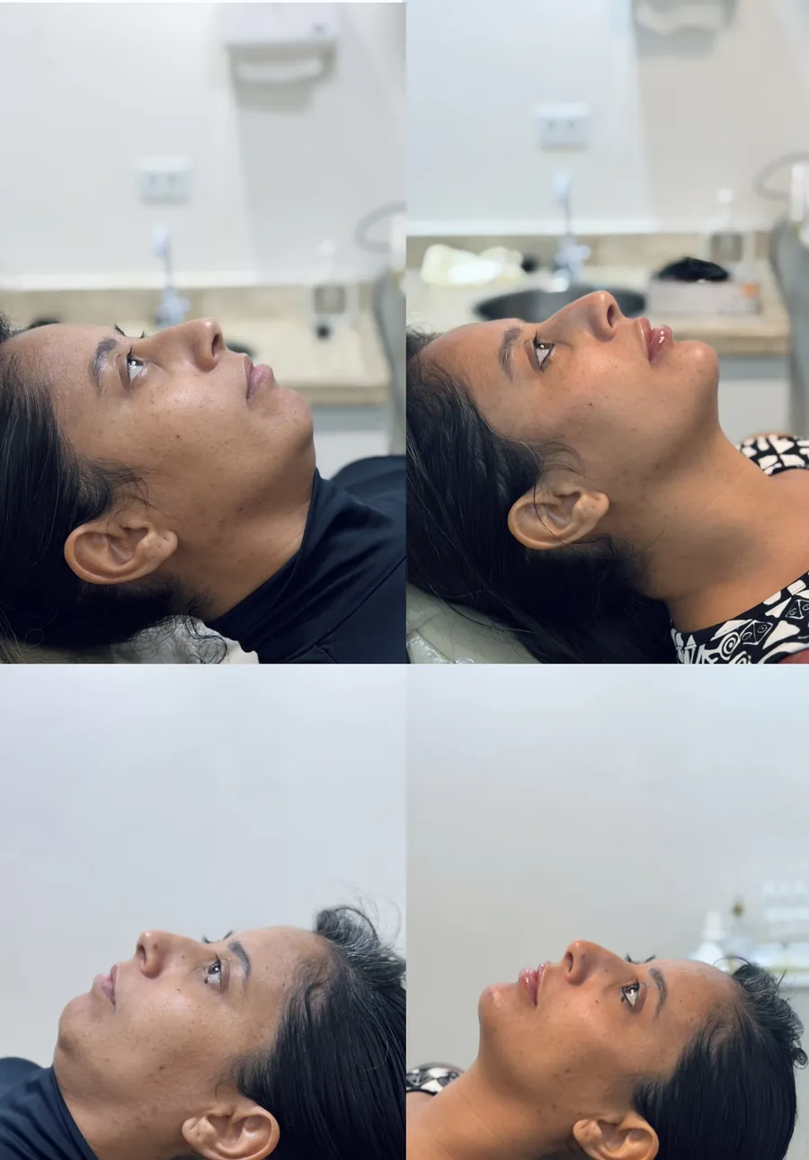 Antes e depois de harmonização facial — vista inferior do perfil